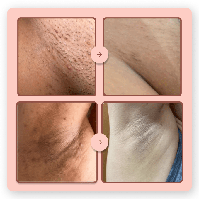 Depilador Anti Foliculite – Pele Lisinha sem Pelos Encravados