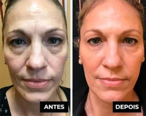 Creme Lifting Firmador Remover Rugas em 60 segundos