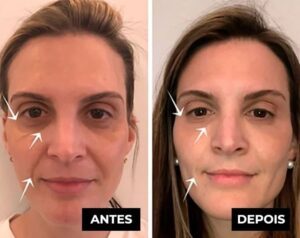 Creme Lifting Firmador Remover Rugas em 60 segundos