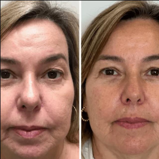 Collagen Fit™ - Máscara Rejuvenescedora de Colagénio, 2 UNIDADES