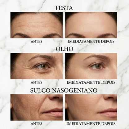 Peter Thom Tensor Facial – Lifting Imediato